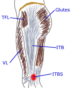 Iliotibial band syndrome (ITBS) - , Running tips
