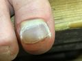 Blister behind toe nail.jpg